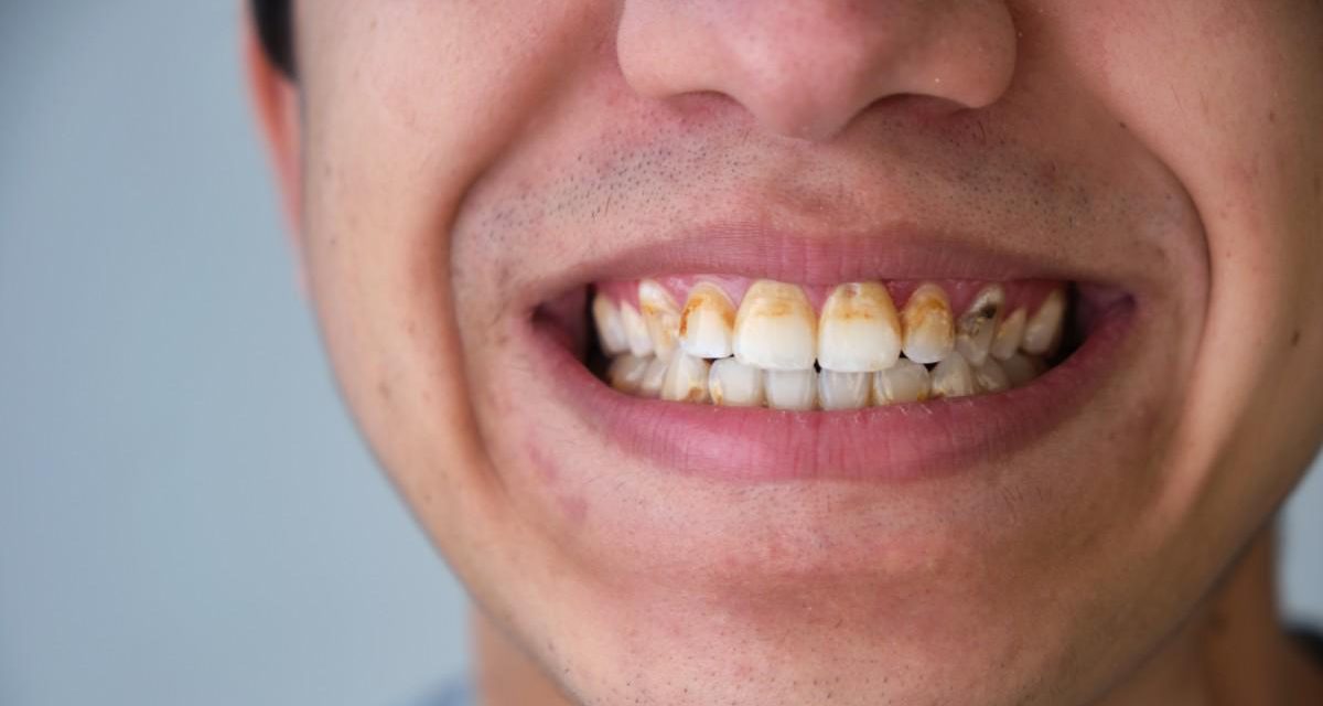Penyebab Terbentuknya Karang Gigi Dan Cara Mencegahnya