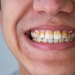 Penyebab Terbentuknya Karang Gigi Dan Cara Mencegahnya