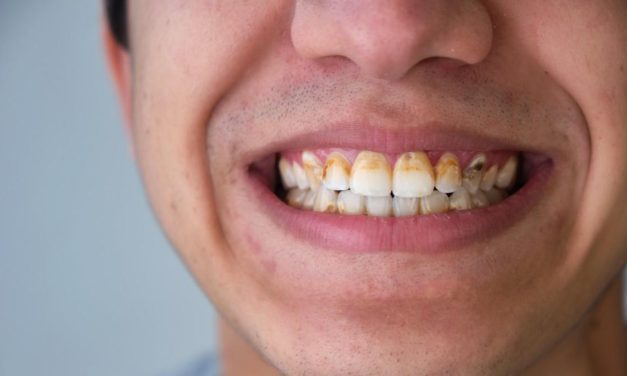 Penyebab Terbentuknya Karang Gigi Dan Cara Mencegahnya